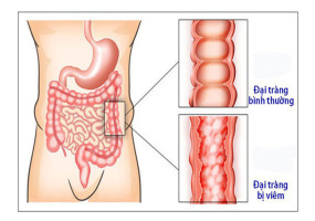 Bệnh viêm đại tràng - Những dấu hiệu & cách điều trị đúng